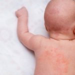 新生児の湿疹