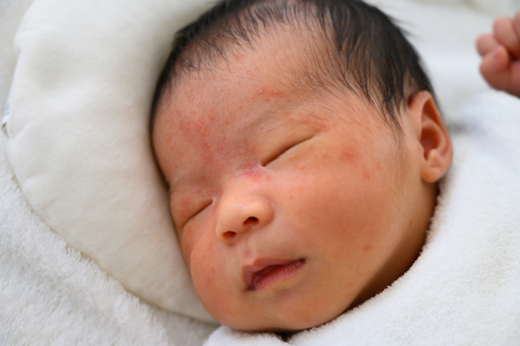 赤ちゃんの湿疹4タイプ 治し方と受診目安 小児科と皮膚科どっち 医師監修 Kosodate Life 子育てライフ