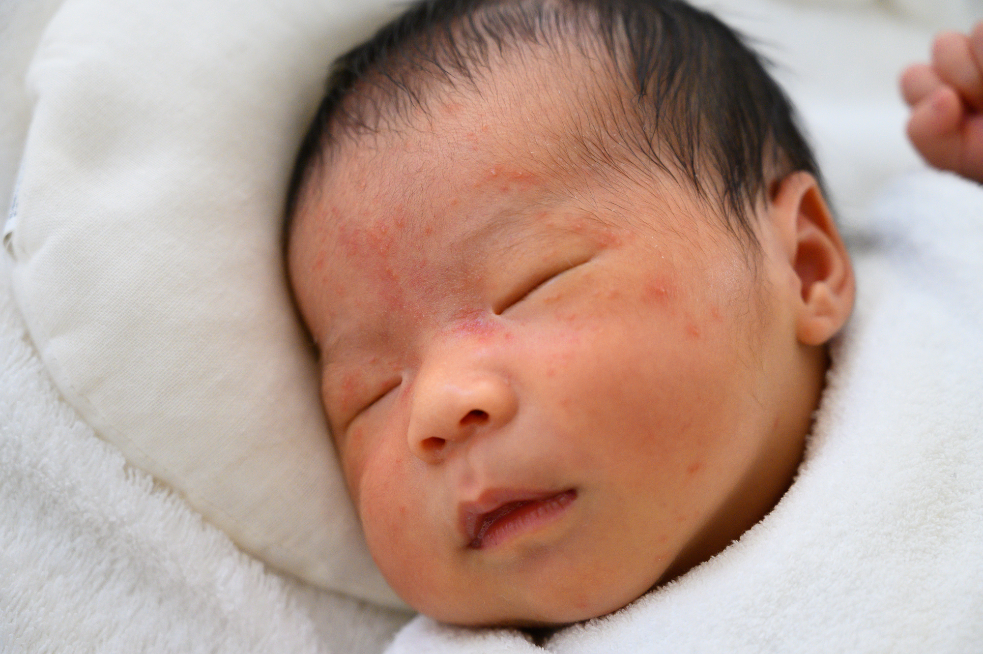 【赤ちゃんの湿疹4タイプ】治し方と受診目安。小児科と皮膚科どっち？｜医師監修