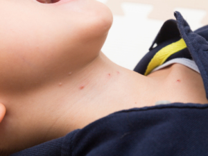 なし 熱 なし 子供 かゆみ 赤い 発疹 子供の発疹。 熱なし、かゆみなしの時に疑われる病気と対処法は？