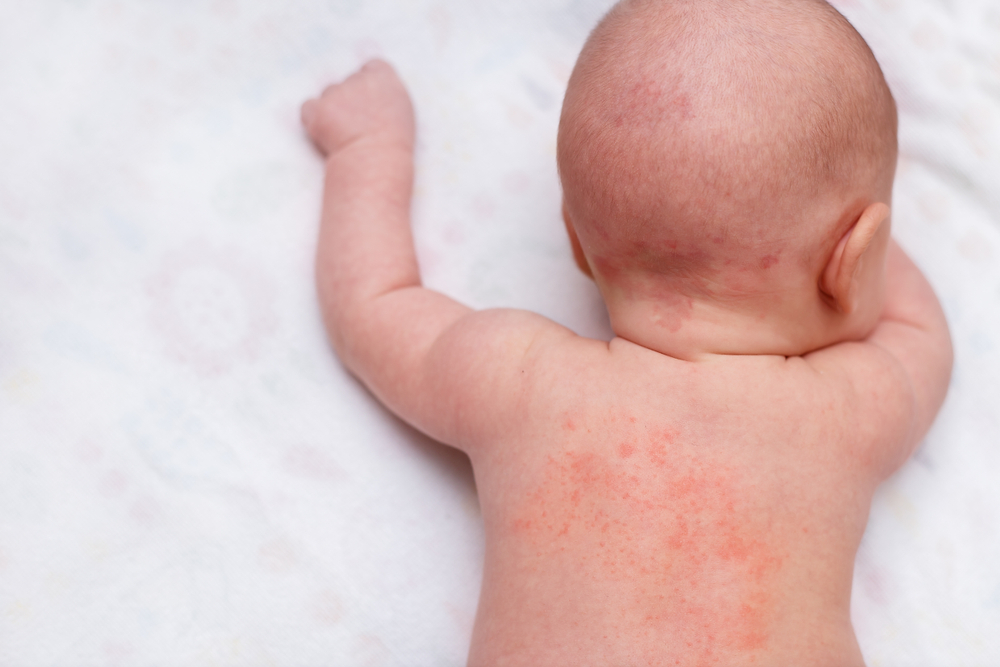 赤ちゃんのお腹 背中に赤い湿疹が あせもやアトピーの正しい対処 医師監修 Kosodate Life 子育てライフ