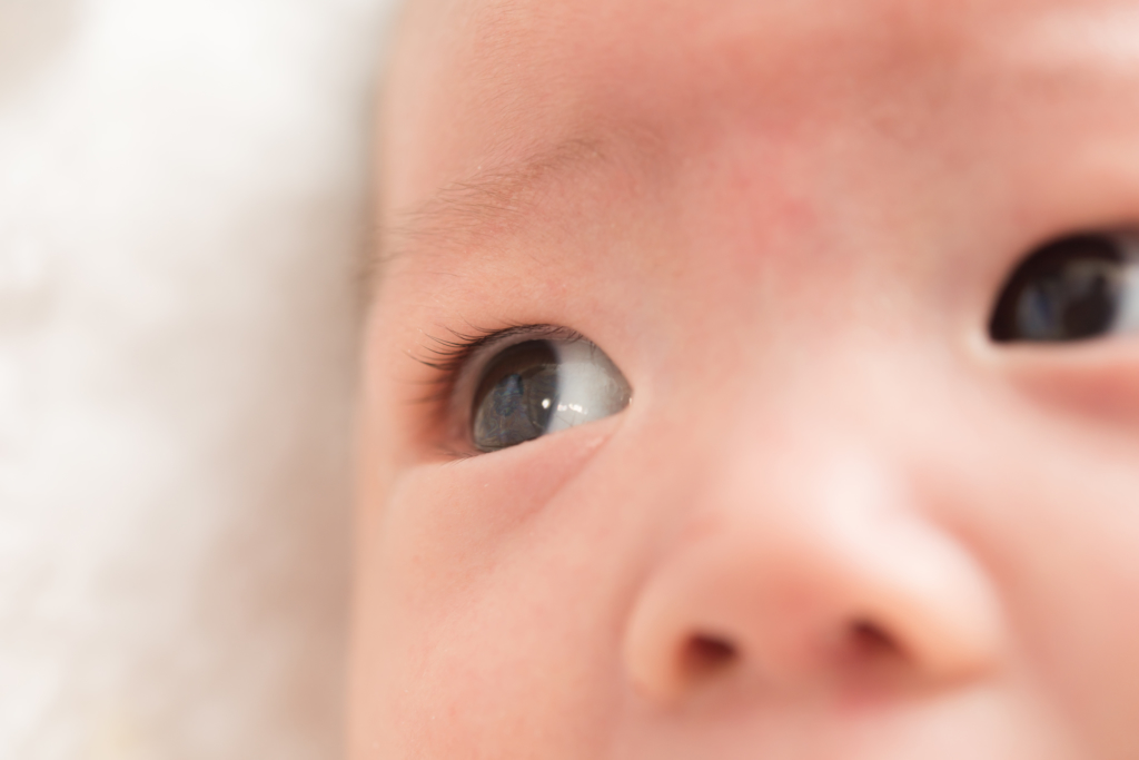赤ちゃんの目が充血 結膜炎やアレルギーかも 病院は眼科 小児科 Kosodate Life 子育てライフ