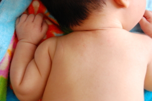 赤ちゃんのお腹・背中に赤い湿疹が！あせもやアトピーの正しい対処【医師監修】
