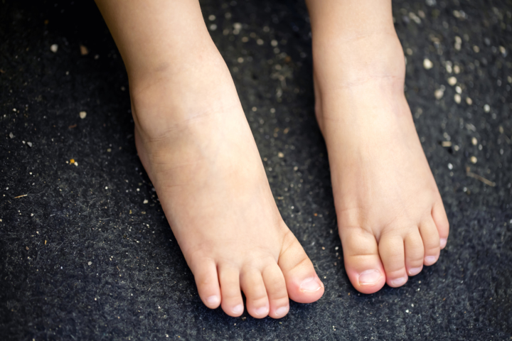 子どもの「足の甲の痛み」歩くと痛い、腫れがあるケースも