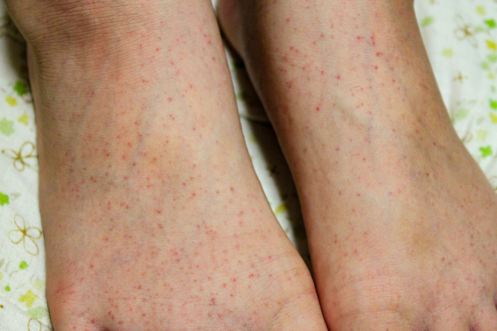 子どもの紫斑病の治療 うつる 治る 何科を受診 手足に赤い斑点がでたら Kosodate Life 子育てライフ