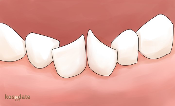 下の永久歯の生え方「斜め」「ハの字」は自然に治る？矯正した方がいい？｜歯科医監修
