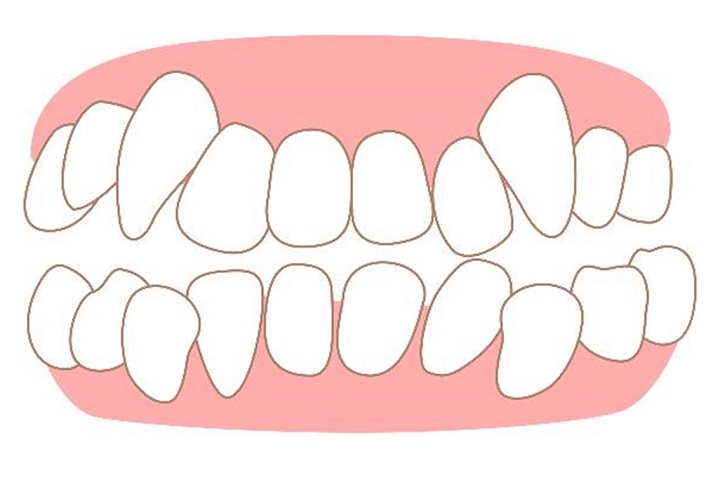 八重歯の生え始めの対処｜自力で治すことはできる？矯正の費用は？