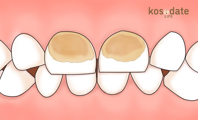 茶色い乳歯は 虫歯 それとも着色汚れ 放置するのは 歯科医監修 Kosodate Life 子育てライフ