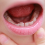 子どもの「舌が痛い」「発熱はない」どうすれば？病院は何科を受診？