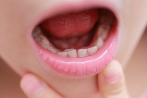 子どもの「舌が痛い」「発熱はない」どうすれば？病院は何科を受診？