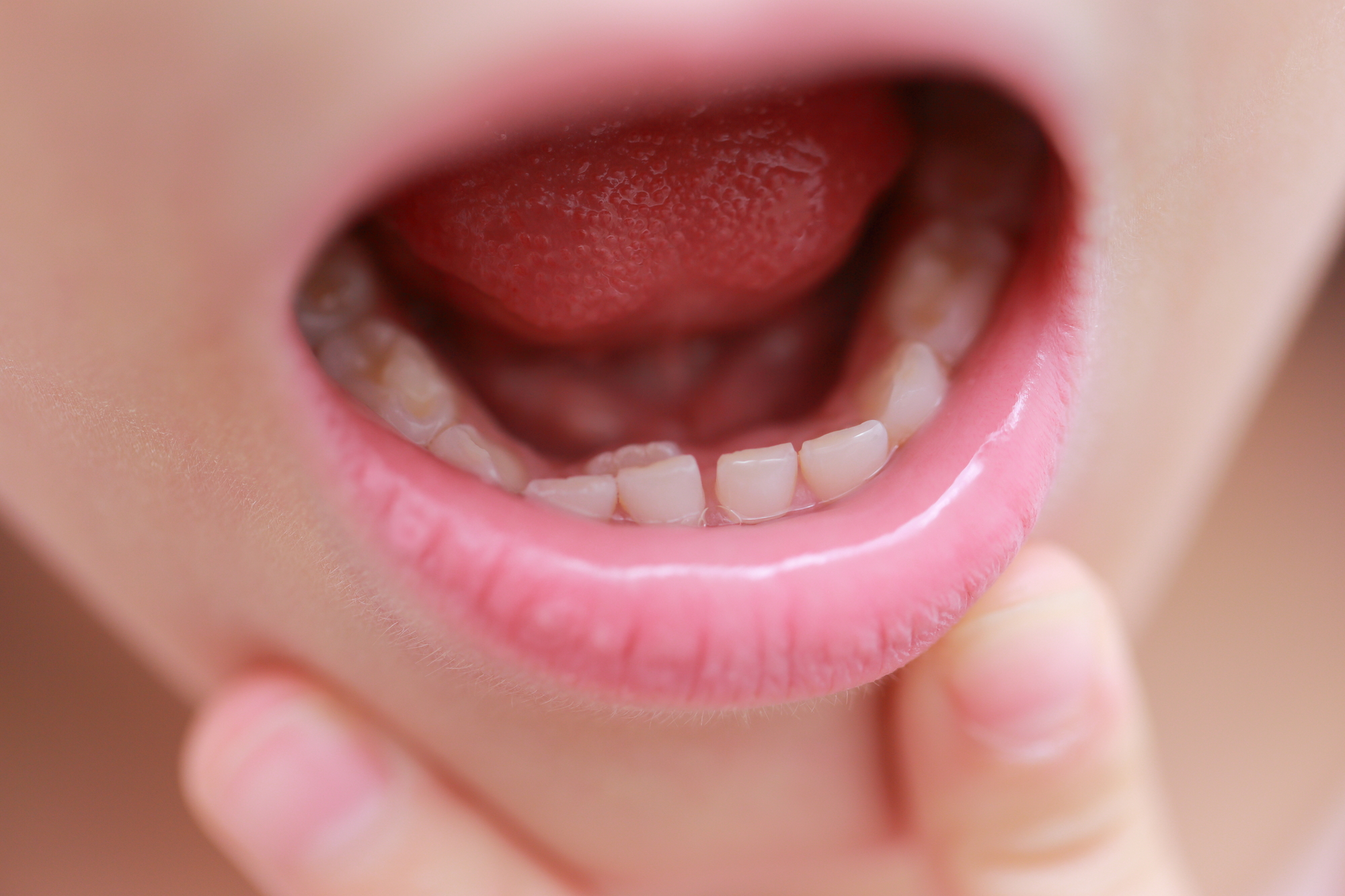 子どもの舌に「白いできもの」大丈夫？痛いケースも。親ができる対処法は？