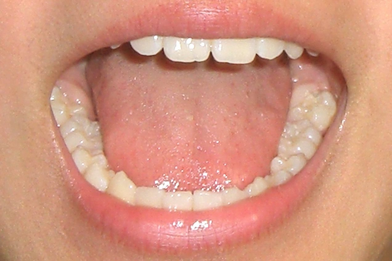 痛い 舌 【舌が痛い.com】舌の痛みの原因・病気・治療