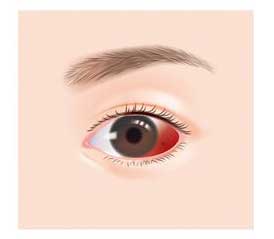 原因 白目 の 出血 結膜下出血（よくある目の病気 39)