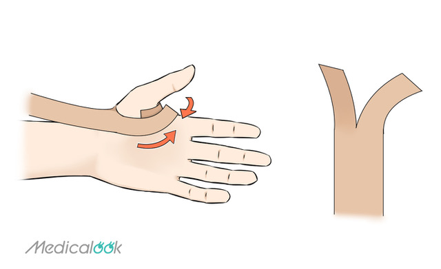 方法 手首 を 治す 捻挫 の 早く 手首の捻挫の治療法とは？症状とテーピングの方法も解説