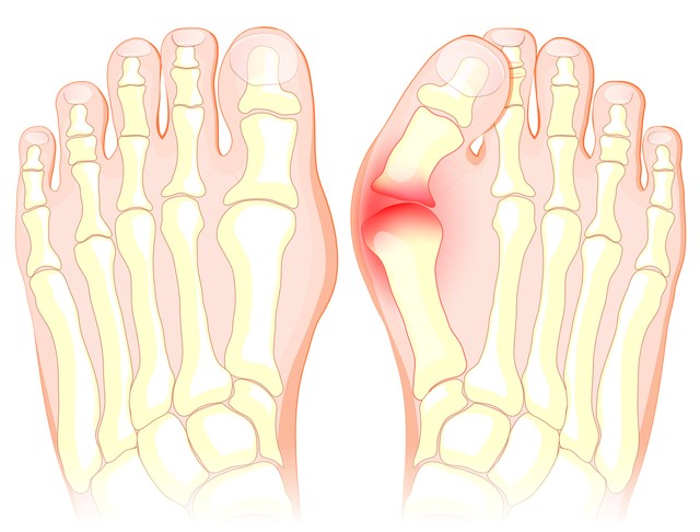 足の親指の付け根が痛い 女性に多い 外反母趾 の対処法 病院は何科 Medicalook メディカルック