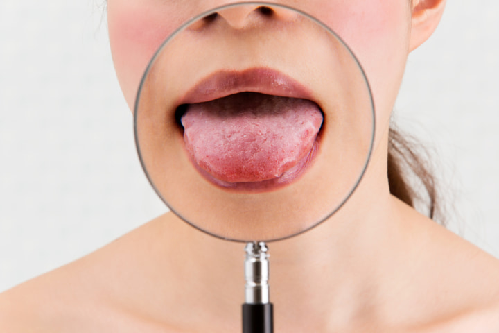 口の中にできた白い膜が取れる 口腔カンジダ の可能性大 対処法は Medicalook メディカルック