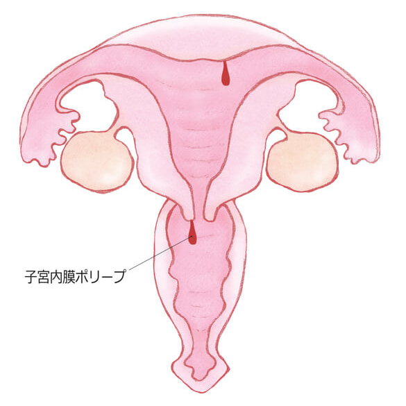 子宮頸管ポリープ