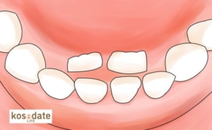 下の歯・上の歯「永久歯が乳歯の内側から生える」どうすれば？｜歯科医監修